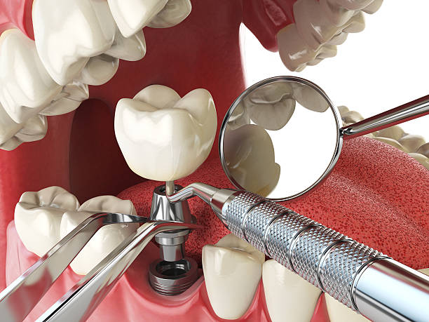 Best Emergency Treatment for Dental Infections or Abscesses in Watertown Town, MA